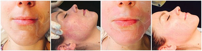 eDermastamp Treatment Phases