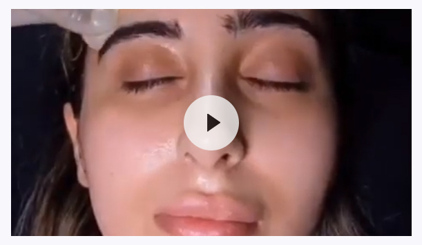 Vampire facelift | PRP Skin Facial Therapy | CosmeDocs